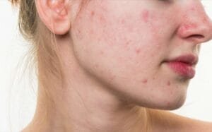 Une poussée d'acné.
