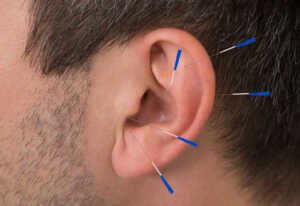 Les points d'acupuncture de l'oreille contre le tabagisme.