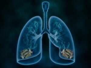 cover-r4x3w1200-5dd6abf13c52c-bpco-mort-fumeur-bronchopneumopathie Le cancer des poumons est souvent causé par le tabagisme.
