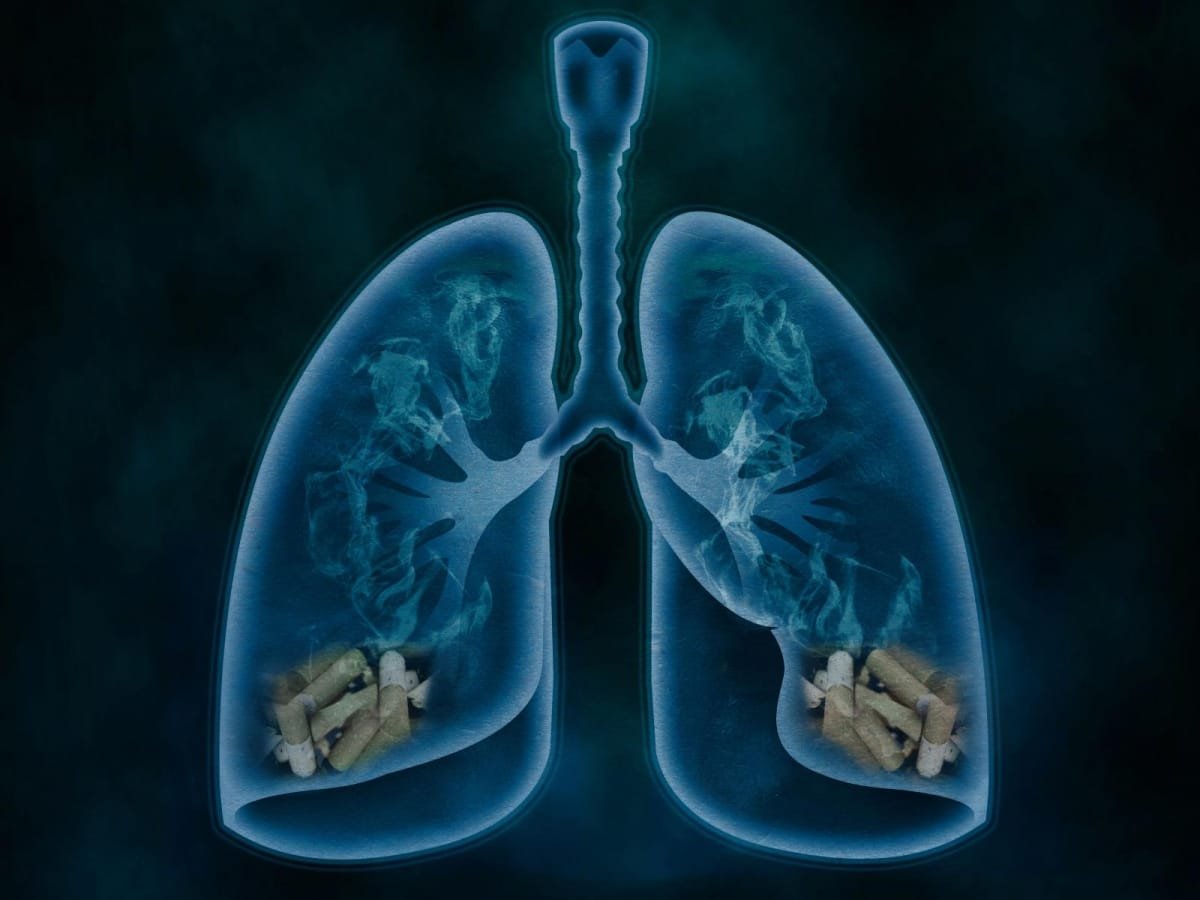 cover-r4x3w1200-5dd6abf13c52c-bpco-mort-fumeur-bronchopneumopathie Le cancer des poumons est souvent causé par le tabagisme.