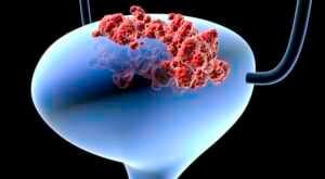 Bladder cancer Les substances nocives filtrées dans l'urine provoquent le cancer de la vessie.