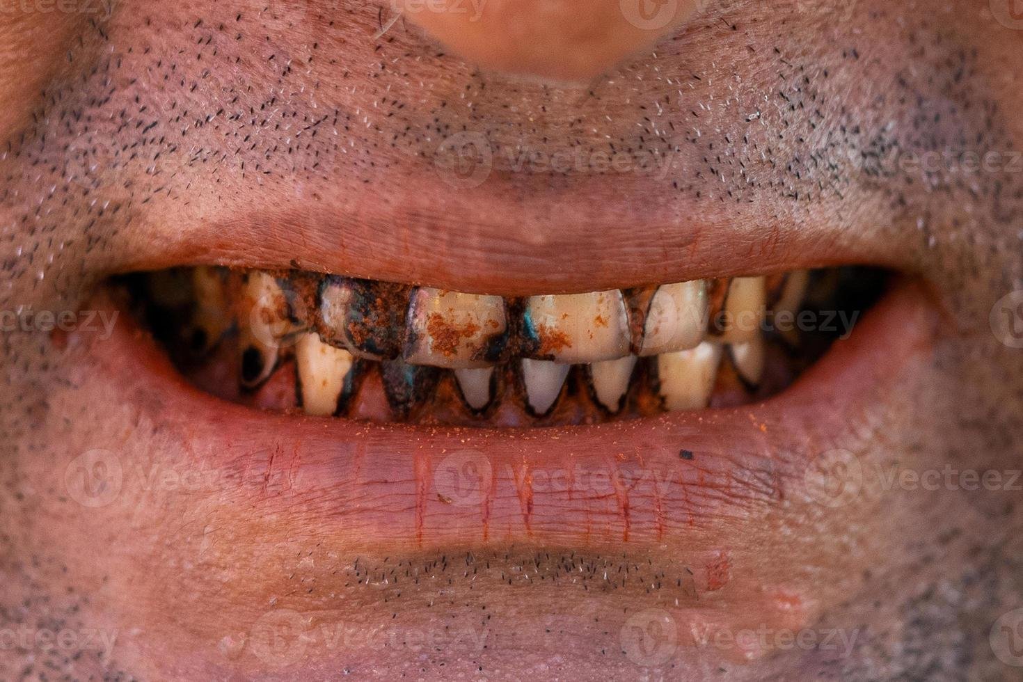 Le tabac cause des dégâts considérables sur les dents.