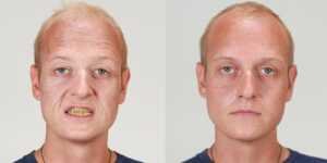 untitled-13 L'apparence physique entre avant et après l'arrêt du tabac.