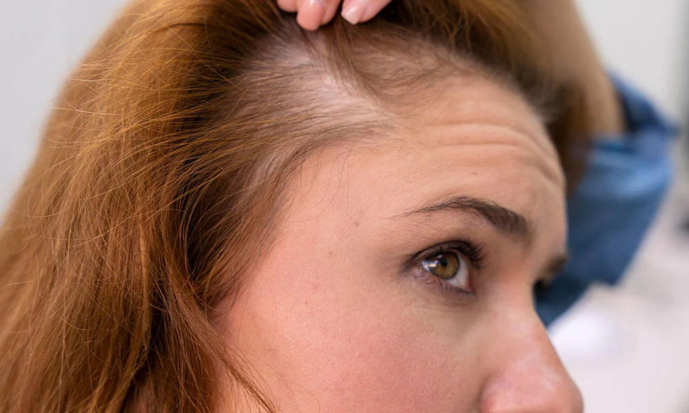 Femme_regardant_sa_perte_de_cheveux_dans_le_miroir_1000x600_ddd63aa0-8abe-4806-8118-baea25af61f7